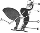   ________ Gartner duct cyst A) A B) B C) C D) D E) E
