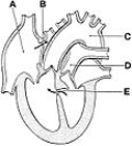   ________ A cardiac defect in the area of the oval fossa A) A B) B C) C D) D E) E