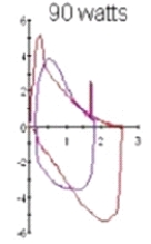 The following image shows the subject's tidal volume plotted against the maximal flow-volume loop during exercise:   Which of the following clinical conditions is most consistent with these findings? A)  Variable intrathoracic obstruction B)  Chronic obstructive pulmonary disease C)  Pulmonary fibrosis D)  Variable extrathoracic obstruction