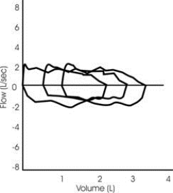 Which answer is consistent with the following three superimposed flow-volume loops?   A)  Normal airway function B)  Small airway obstruction C)  Variable intrathoracic restriction D)  Fixed extrathoracic obstruction