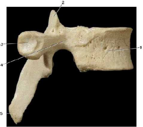   -In the above right lateral view of a vertebra,number 1 indicates what bony landmark? A) pedicle B) superior articular process C) body D) transverse process
