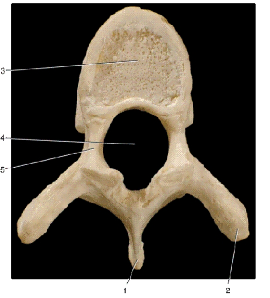   -In the above superior view of a vertebra,number 1 indicates what bony landmark? A) transverse process B) vertebral arch C) lamina D) spinous process