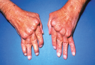 The patient presents with contracture deformities of the hand and complains of severe pain. What musculoskeletal disorder does this patient manifest?   A)  Rheumatoid arthritis B)  Osteomyelitis C)  Osteoporosis D)  Ankylosing spondylitis 