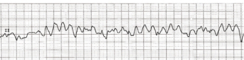 Identify the ECG rhythm.   A)  Ventricular fibrillation B)  Atrial flutter C)  Sinus tachycardia D)  Ventricular tachycardia 