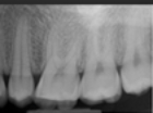 Identify this image;it is mounted using the labial view.   A) Maxillary right molars B) Maxillary left premolars C) Maxillary left molars D) Mandibular left molars