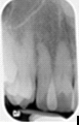 Identify this image;it is mounted using the labial view.   A) Maxillary right canine B) Maxillary left canine C) Maxillary right incisors D) Maxillary left incisors