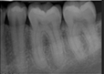 Identify the major placement error in this molar radiograph.   A) Too far mesial B) Too far distal C) Vertical angulation D) Horizontal angulation