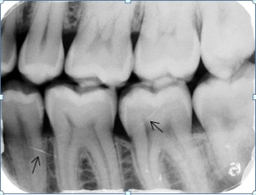 Identify the cause of the lines the arrows are pointing to on your patient's dental image.     A) Fractures in the root and crown B) Scratched film emulsion C) Artifacts on the phosphor plates D) Streaks of light