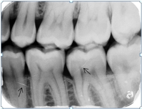 Identify the cause of the lines the arrows are pointing to on your patient's dental image.     A) Fractures in the root and crown B) Scratched film emulsion C) Artifacts on the phosphor plates D) Streaks of light