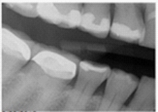 Identify the major technique error on your patient's bitewing.   A) Overlap B) Vertical angulation C) Cone-cut D) Occlusal plane not centered