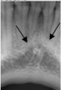Identify this landmark.   A) Genial tubercles B) Mental ridge C) Mental fossa D) Mylohyoid ridge