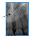 Identify this landmark.   A) Incisive foramen B) Nasal fossa C) Nasal septum D) Nasal spine