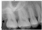 Identify this landmark on your patient's dental image.   A) Lateral pterygoid plate B) Maxillary tuberosity C) Zygoma D) Maxillary sinus