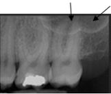 Identify this landmark.   A) Maxillary tuberosity B) Zygoma C) Maxillary sinus D) Mylohyoid bone