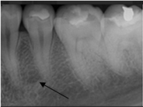 <strong>What is the arrow pointing to on your patient's dental image?  </strong> A)Periapical abscess B)Trabecular bone C)Mental foramen D)Periodontal abscess <div style=padding-top: 35px> 