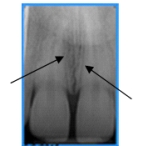 Identify the landmark the arrows are pointing to on your patient's dental image.   A) Nose B) Incisive foramen C) Midpalatine suture D) Lateral fossa