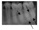 Identify this landmark.   A) External oblique ridge B) Submandibular fossa C) Mylohyoid ridge D) Mandibular canal