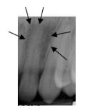 What are the arrows pointing to?   A) Periodontal abscess B) Incisive foramen C) Lateral fossa D) Periapical abscess