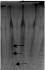 Identify the radiolucent area the arrows are pointing to.   A) Mental fossa B) Periodontal pocket C) Mental ridge D) Nutrient canal