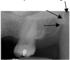 Identify the radiopaque area the arrows are pointing to.   A) Maxillary tuberosity B) Coronoid process C) Condyle D) Spine