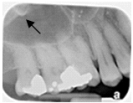 Identify the radiopaque area the arrows are pointing to.   A) Maxillary sinus B) Lateral pterygoid plate C) Orbit D) Zygoma