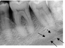 Identify the area the arrows are pointing to on your patient's dental image.   A) Mandibular canal B) Submandibular fossa C) Mylohyoid ridge D) Border of the mandible