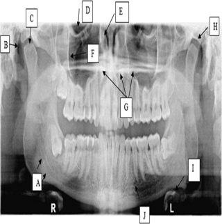 Use the image to answer the following questions.    -Nasal conchea A) Label B B) Label E C) Label F D) Label H