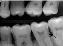 Identify the radiopaque area the arrow is pointing to on your patient's dental image.   A) Calculus B) Caries C) Cemento-enamel junction D) Cementum