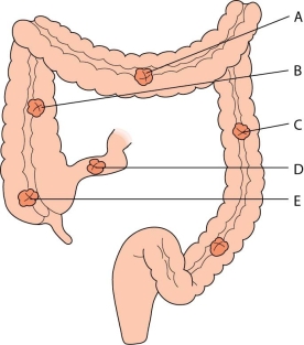 The nurse is caring for a client with colorectal cancer who is post-operative from a transverse colostomy placement.What area of the bowel is involved?   A)  A B)  B C)  C D)  D E)  E
