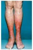 A nurse is caring for a client diagnosed with Erysipelas whose lower extremities are bright red and raised with well-defined borders.(See image.) Which is the most likely causative organism of this condition?   A)  Group B streptococcus. B)  Group A streptococcus. C)  Staphylococcus aureus. D)  Candida albicans.