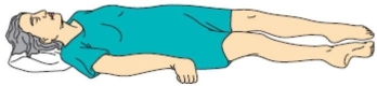 The nurse becomes concerned when a client who sustained a head injury from a motor vehicle crash begins to demonstrate an abnormal posture.(See image) .What does this posture suggest to the nurse about the client's brain functioning?   A)  Altered level of consciousness B)  Developing a seizure disorder C)  Brain stem impairment D)  Corticospinal tract impairment