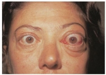 A client with exophthalmos is pictured below.Which conclusion by the nurse is appropriate?   A)  This condition is caused by hypothyroidism. B)  Treatment for this condition reverses the symptoms of exophthalmos. C)  This condition is caused by Hashimoto thyroiditis. D)  Women with this condition may have fertility problems.