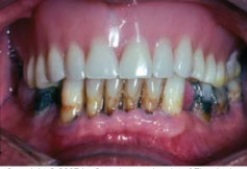 Mr.SJB is 56 years of age.He has had a full upper denture for 4 years and has not been back to the dentist since it was completed.He has 5- to 6-mm probing depths,several millimeters of recession around all of his remaining teeth,and the gingiva readily bleeds when probed.Observation reveals that he has heavy subgingival calculus,staining,root caries,and heavy deposits of plaque biofilm.The dental hygienist will provide preventive care and scale his remaining teeth.The likely overall prognosis for this patient is:   A)  Excellent B)  Good C)  Poor to fair D)  Questionable E)  Hopeless