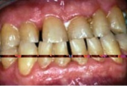 A 68-year-old man has never been a regular visitor to the dentist.He is generally uncooperative but came to the appointment because his  gums bleed  and he has  bad breath.  He is in good health and takes no medications.He has 4- to 6-mm pocket depths,little recession,heavy deposits of subgingival calculus,and heavy supragingival plaque biofilm throughout.The treatment plan consists of oral hygiene instructions,quadrant scaling and root planing,and re-evaluation for referral to a periodontist.The global prognosis for this patient is most likely:   A)  Excellent B)  Good C)  Poor to fair D)  Questionable E)  Hopeless