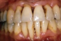 Mr.CAA is 37 years old and has had repeated episodes of both nonsurgical and surgical periodontal therapy.He is conscientious about his oral hygiene and follows all treatment recommendations.He has also been on a 1-year course of low-dose doxycycline as an adjunct to periodontal therapy.Mr.CAA is in good health and takes no other medications but smokes two packs of cigarettes a day and has been unable to quit.The overall prognosis for Mr.CAA is most likely:   A)  Excellent B)  Good C)  Poor to fair D)  Questionable E)  Hopeless