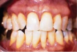 Ms.JTW is 40 years old and in excellent health.She has had periodontal therapy in the past,including surgery in the posterior sextants,and has been maintained for the past few years on 3-month recalls.Ms.JTW has recently moved to a new location to take a different job and is going through a divorce.When she arrives for her recall visit this time,the dental hygienist notes generalized gingivitis throughout her dentition.The dental hygienist provides Ms.JTW with oral hygiene instruction,scales and polishes her teeth (she is concerned about light staining) ,and asks her to return in 2 months for her next recall appointment.The global prognosis for this patient is likely to be:   A)  Excellent B)  Good C)  Poor to Fair D)  Questionable E)  Hopeless