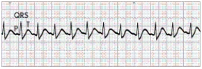A patient who is complaining of a  racing  heart and feeling  anxious  comes to the emergency department.The nurse places the patient on a heart monitor and obtains the following electrocardiographic (ECG) tracing.   Which action should the nurse take next? A)  Prepare to perform electrical cardioversion. B)  Have the patient perform the Valsalva maneuver. C)  Obtain the patient's vital signs including oxygen saturation. D)  Prepare to give a â-blocker medication to slow the heart rate.