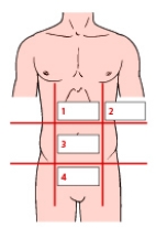 In reviewing the medical record shown in the accompanying figure for a patient admitted with acute pancreatitis,the nurse sees that the patient has a positive Cullen's sign.Indicate the area where the nurse will assess for this change.   A)  1 B)  2 C)  3 D)  4