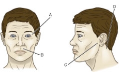 Which is the correct point on the accompanying figure where the nurse will assess for ecchymosis when admitting a patient with a basilar skull fracture?   A)  A B)  B C)  C D)  D