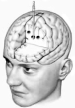   -Which prefrontal lobotomy procedure is illustrated by this drawing? A)  the procedure used by Freeman in Canada B)  the procedure of Moniz and Lima C)  the improved prefrontal lobotomy procedure developed in Sweden D)  the transorbital prefrontal lobotomy E)  both B and C