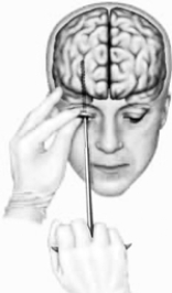  -This drawing illustrates A)  Lima's original prefrontal lobotomy. B)  Moniz's original prefrontal lobotomy. C)  a transorbital prefrontal lobotomy. D)  both A and B E)  both B and C