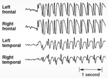 <strong> Illustrated here are EEG discharges characteristic of</strong> A) petit mal seizures. B) grand mal seizures. C) simple partial seizures. D) complex partial seizures. E) myoclonic seizures.