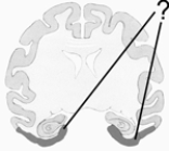 Here is an illustration of coronal section of a monkey brain cut through the hippocampus and amygdala. The shaded area indicates the position of the   A)  hippocampus. B)  rhinal cortex portion of the medial temporal cortex. C)  amygdala. D)  parietal cortex. E)  none of the above