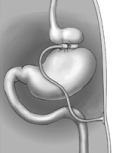 Which surgical procedure is illustrated here?   A)  gastric bypass B)  adjustable gastric band C)  sham eating D)  all of the above E)  both A and B