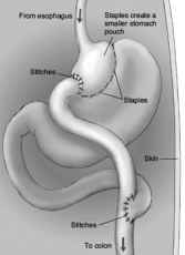 The surgical treatment for extreme obesity that is portrayed in this illustration is __________ surgery.  