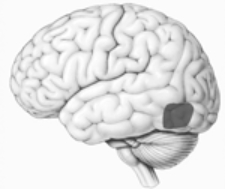 What neuropsychological disorder is associated with damage to the illustrated cortical area?   A)  prosopagnosia B)  akinetopsia C)  agnosia D)  blindsight E)  scotoma