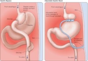 People who suffer from anorexia nervosa A) eat little. B) have usually followed strict diets in the past. C) often perceive their bodies as fat despite their emaciated appearance. D) all of the above E) none of the above