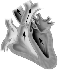 Which of the following describes the stage of the cardiac cycle shown?   A) AV valves closed,SL valves open,ventricles contracting B) AV valves open,SL valves closed,ventricles contracting C) AV valves closed,SL valves open,ventricles relaxed D) AV and SL valves both open,ventricles contracting