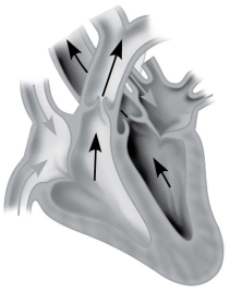 Which of the following describes the stage of the cardiac cycle shown?   A) AV and SL valves both open, ventricles contracting B) AV valves open, SL valves closed, ventricles contracting C) AV valves closed, SL valves open, ventricles contracting D) AV valves closed, SL valves open, ventricles relaxed