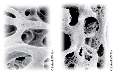 Which of the following treatments could possibly help to transform the bone on the right to the bone on the left?   A) wearing long sleeves while out in the sun B) swimming for 30 minutes a day C) removing calcium from the diet D) taking vitamin D supplements
